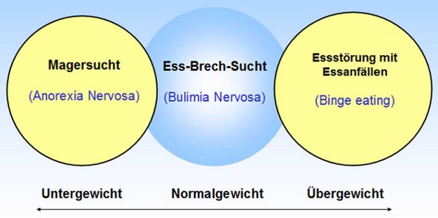 Schaubild Diagnosekriterien der verschiedenen Essstörungen